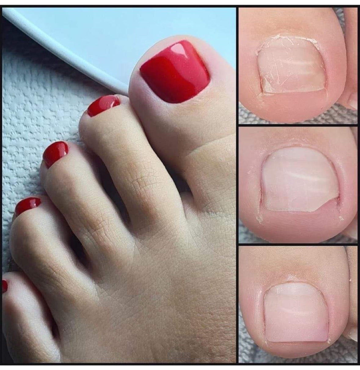 Nail Antifungal Gel Anti-Infection Infected Nail Infection Nail Ringworm  Nail Toe Nail Fungus Removal Feet Care Serum Pen Skinca - AliExpress